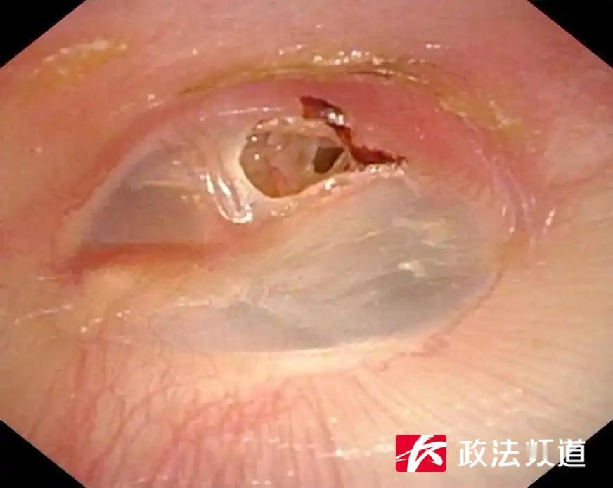 辅导学习起争执，妈妈一巴掌致11岁儿子鼓膜穿孔

近日，湖南省儿童医院接诊了一名