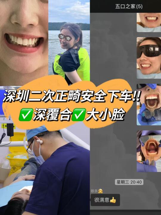 深圳二次正畸遇主任院长，1.5w终获自然咬合