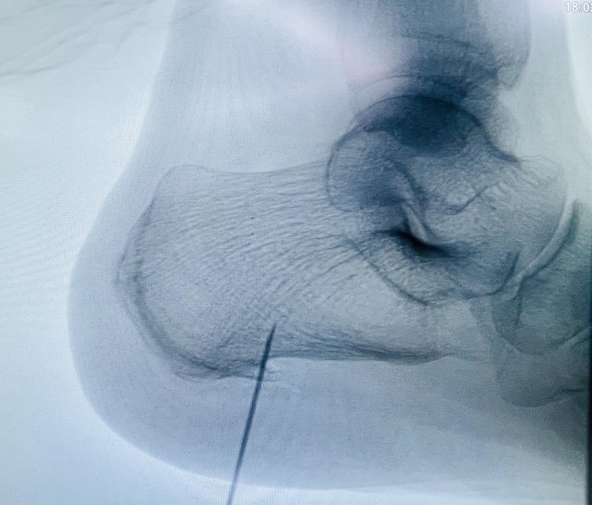 重获轻盈步伐。—— 关节镜下骨刺去除和跖筋膜松解术。医生通过两个小切口...