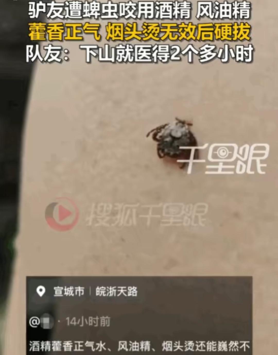 安徽宣城，一男子徒步至半山腰时，不幸被蜱虫紧紧咬住。因下山就医需两小时以上，同伴