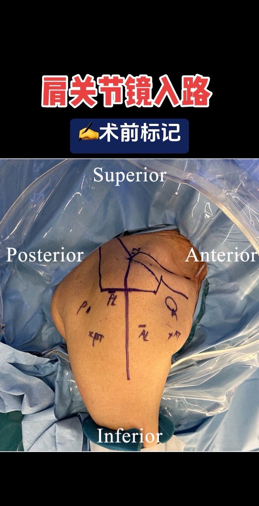 肩关节镜入路。肩关节手术的"GPS导航"，这些标记线才是肩关节镜的关键...
