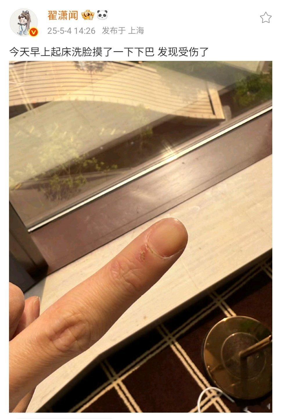 翟潇闻摸了一下下巴受伤了翟潇闻被下颌线划伤了翟潇闻的抽象真的来的措手不及[允悲]