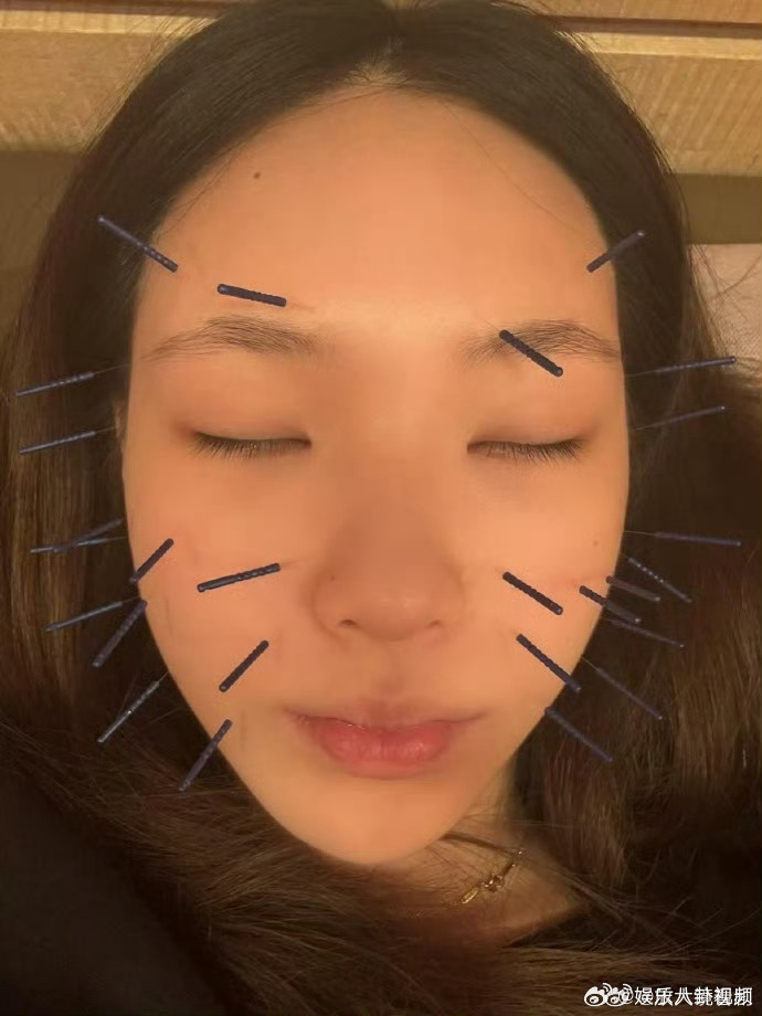 小S大女儿晒面部针灸小S大女儿面部针灸  Elly许曦文晒出脸部理疗搭配拔罐照片