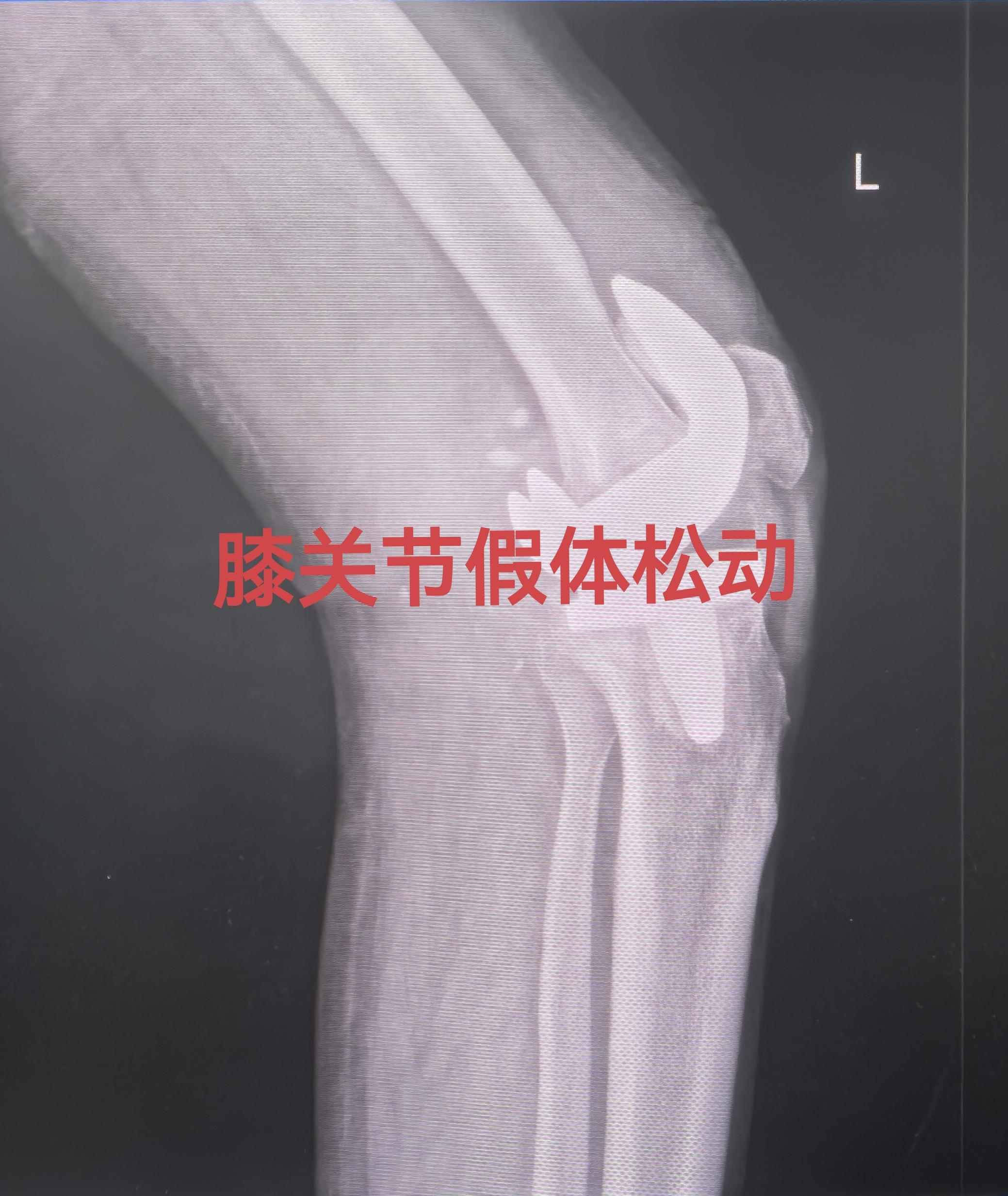 膝关节翻修。80岁老爷子，膝关节置换术后假体松动，一期翻修，再次续命20年🌹