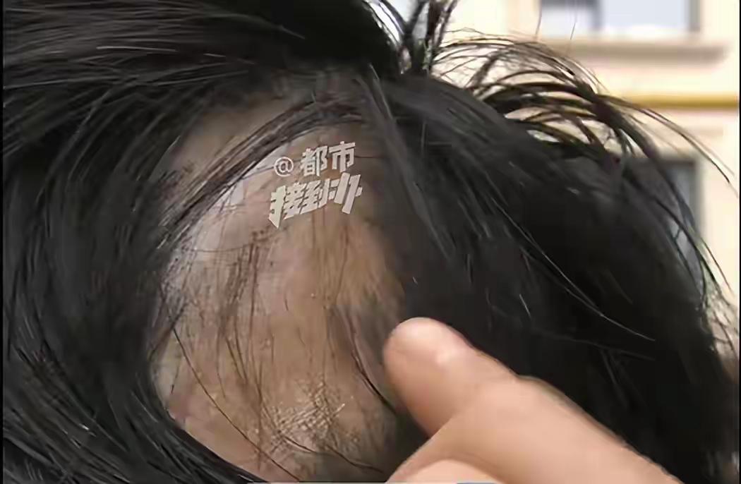 河南开封，一女孩为了让头发更丝滑，去医美机构花了3600元给头皮打了3针玻尿酸，