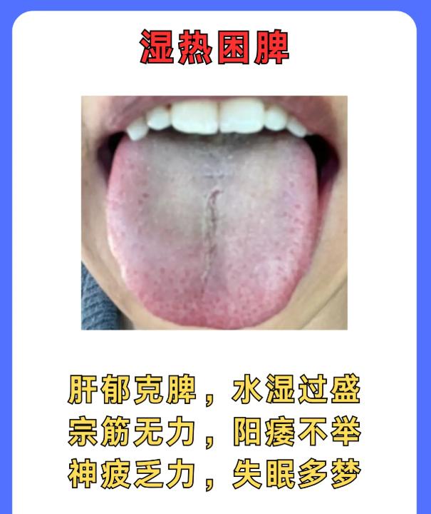 4 种体虚舌象，对症调理不踩坑