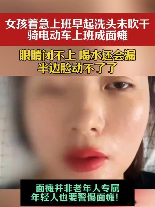 洗头没吹干直接睡觉 女孩醒来确诊面瘫有个姑娘晚上洗头，懒劲儿上来吹风机一扔，湿着