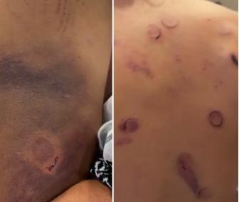 抵达土耳其的全球人道主义船队成员伤痕累累，这是他们展示身上的伤口。

这支船队由