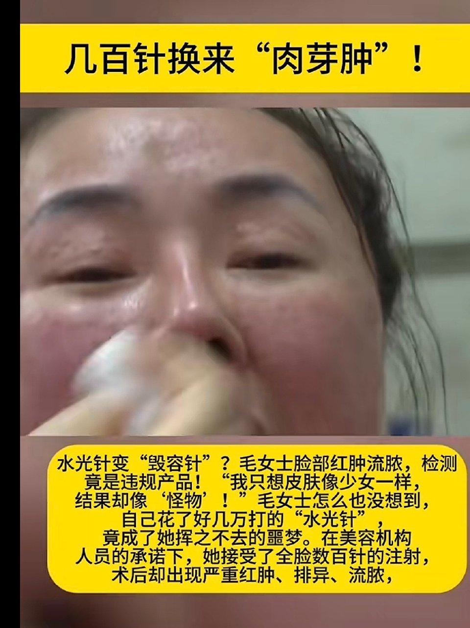 女子打水光针后吃小龙虾，满脸长出肉芽肿，医美后忌口真不是小事
 
爱美之心人皆有
