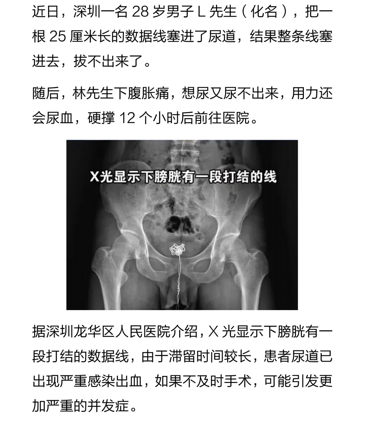男子往尿道塞25厘米数据线，硬撑12小时。 