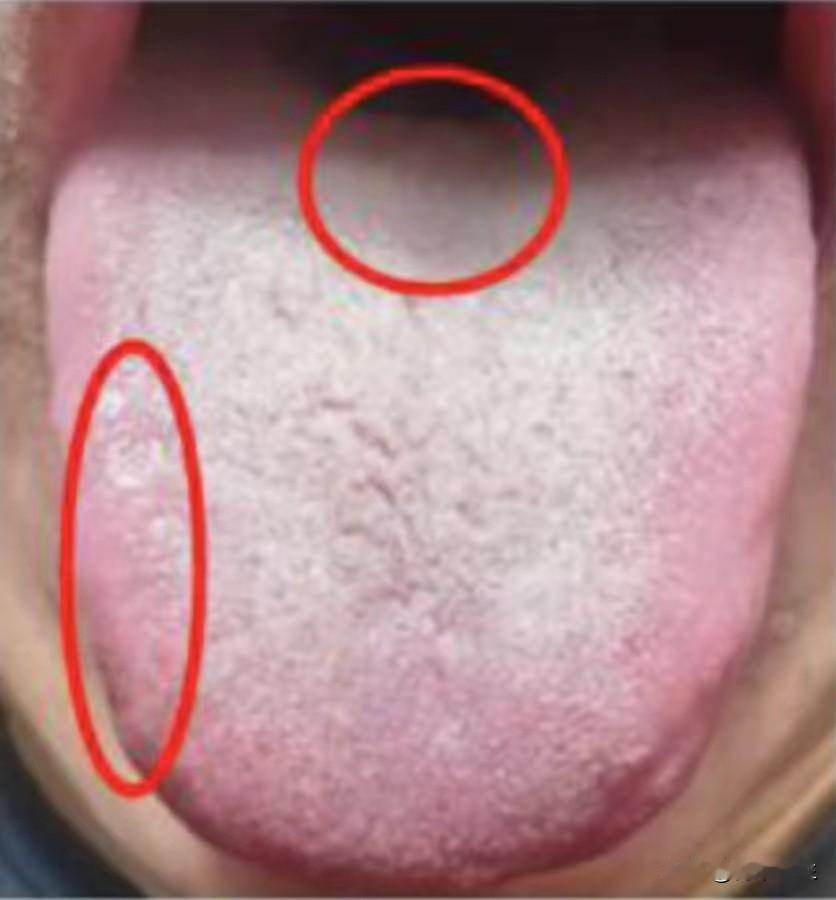 肾虚不可怕，怕的是脾肾双虚，精血化生之源都受损了，这样的舌象再拖下去，可真的补不