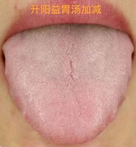 这种舌头想靠参苓白术散祛湿？基本是没有用的！
 
患者情况：口干口苦，腹胀，食欲
