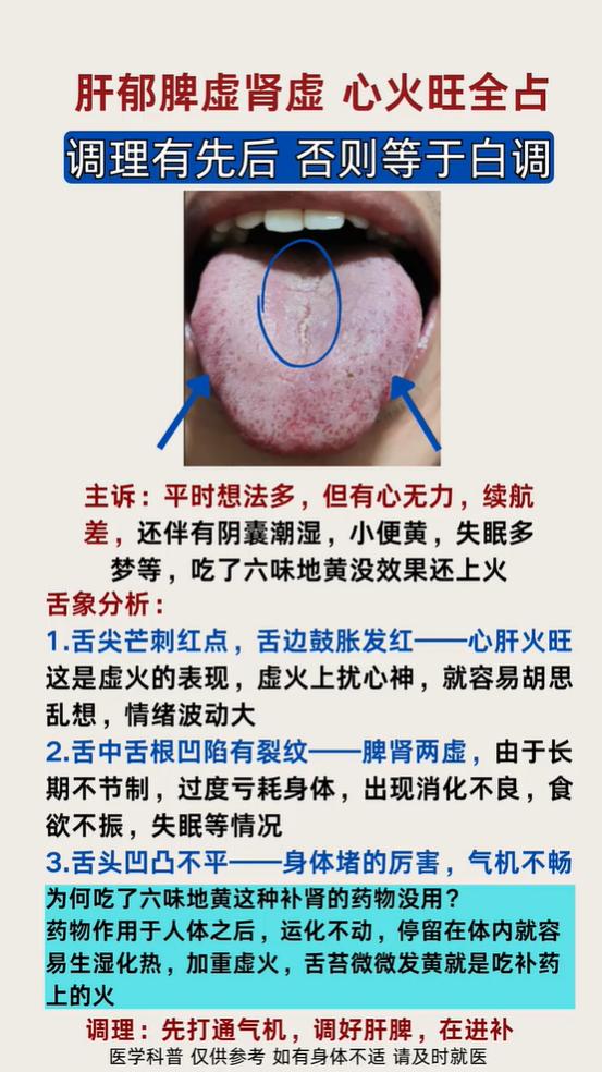 舌边红、舌根裂纹是心肝脾肾同虚，先通后补改善海绵体状态