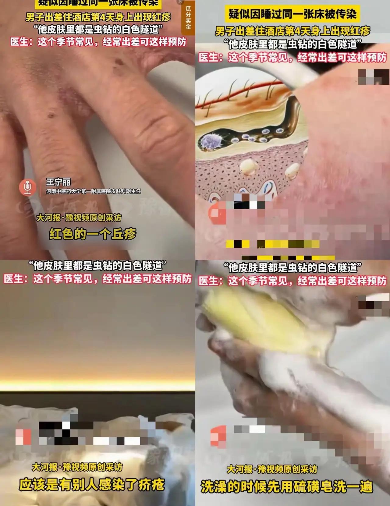 出差住酒店的朋友们得留神了。

有人因为在外住了一晚，身上就起了红疹，医院诊断是