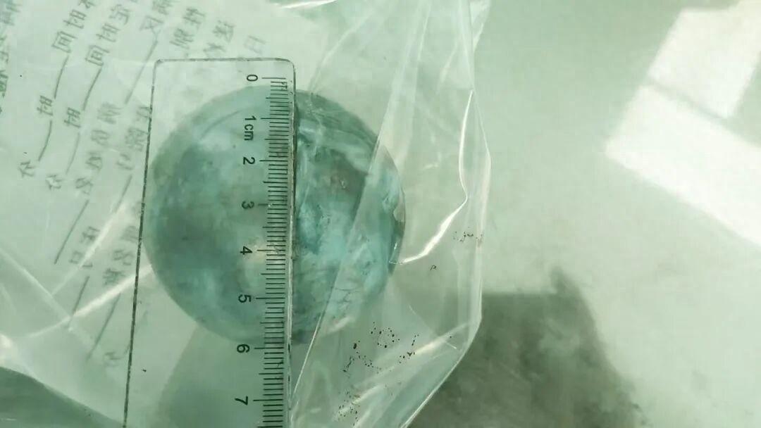 真别乱尝试！福建漳州一名24岁小伙子，因为一时好奇，硬生生把一枚筋膜球塞进肛门，