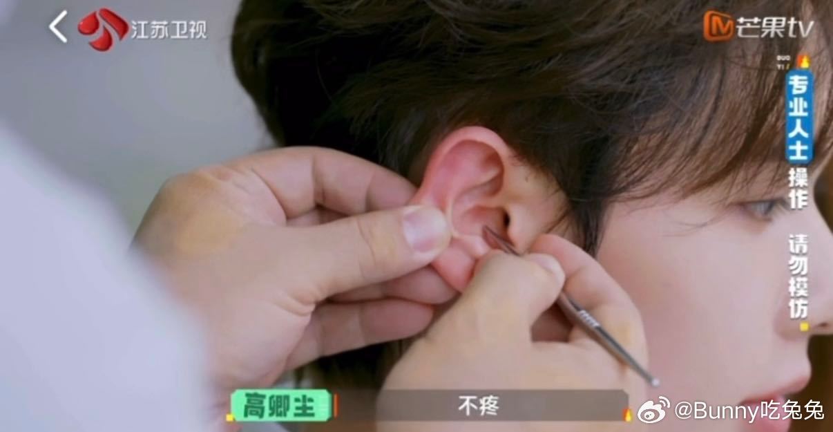 高卿尘先天性耳前瘘管 高卿尘耳前瘘管 实用健康知识点收好！高卿尘耳前小孔是先天性