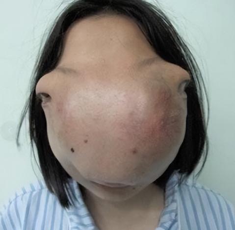 2009年，一名22岁浙江女孩因长了一张怪脸，被迫蒙面生活13年，当她好不容易凑