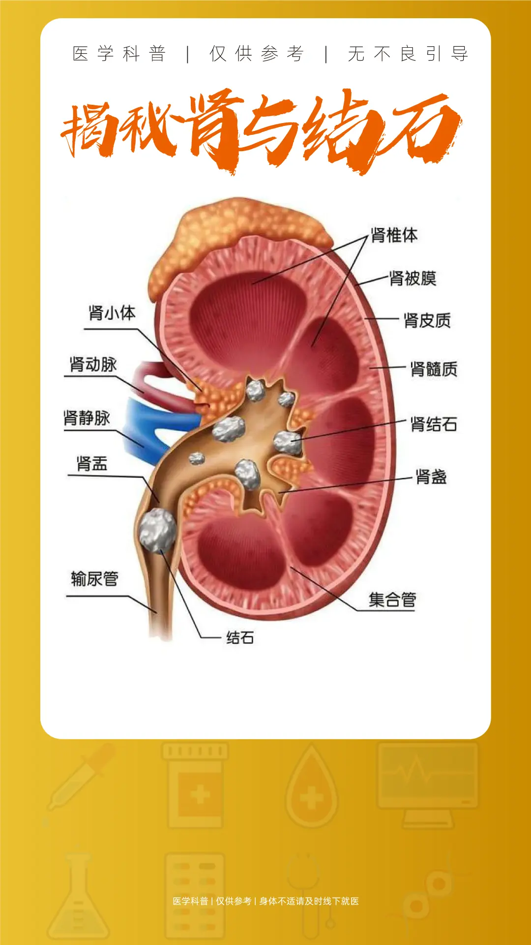 肾结石大揭秘！