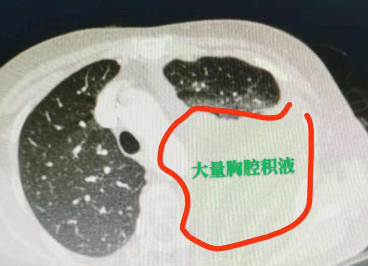 好好的人，为何会突然查出肿瘤？不少人体检突然查出肿瘤后，总觉得是自己运气差、命不