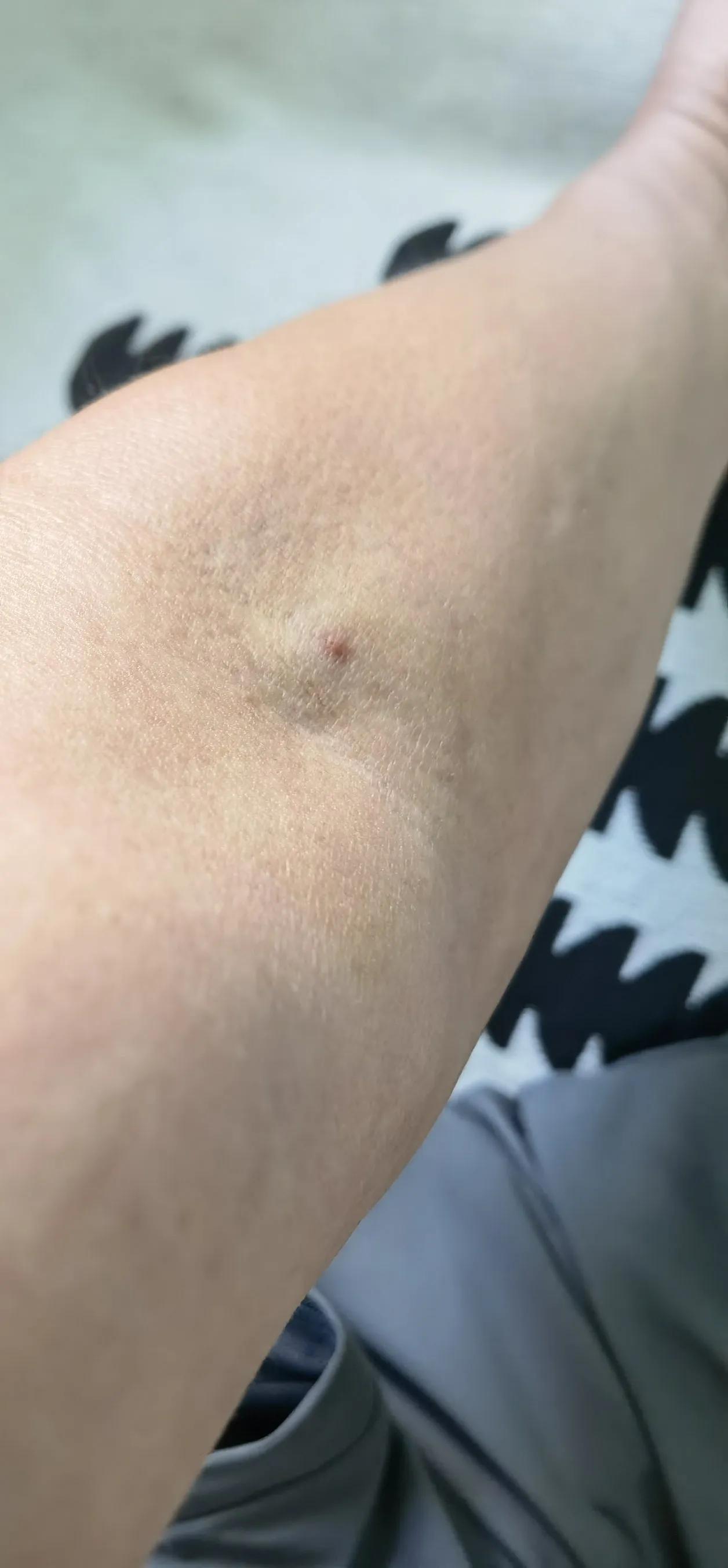 刚刚去社区医院体检。
胳膊抽血后留下的针眼。
小腿蚊子叮咬后留下的“针眼”。
不