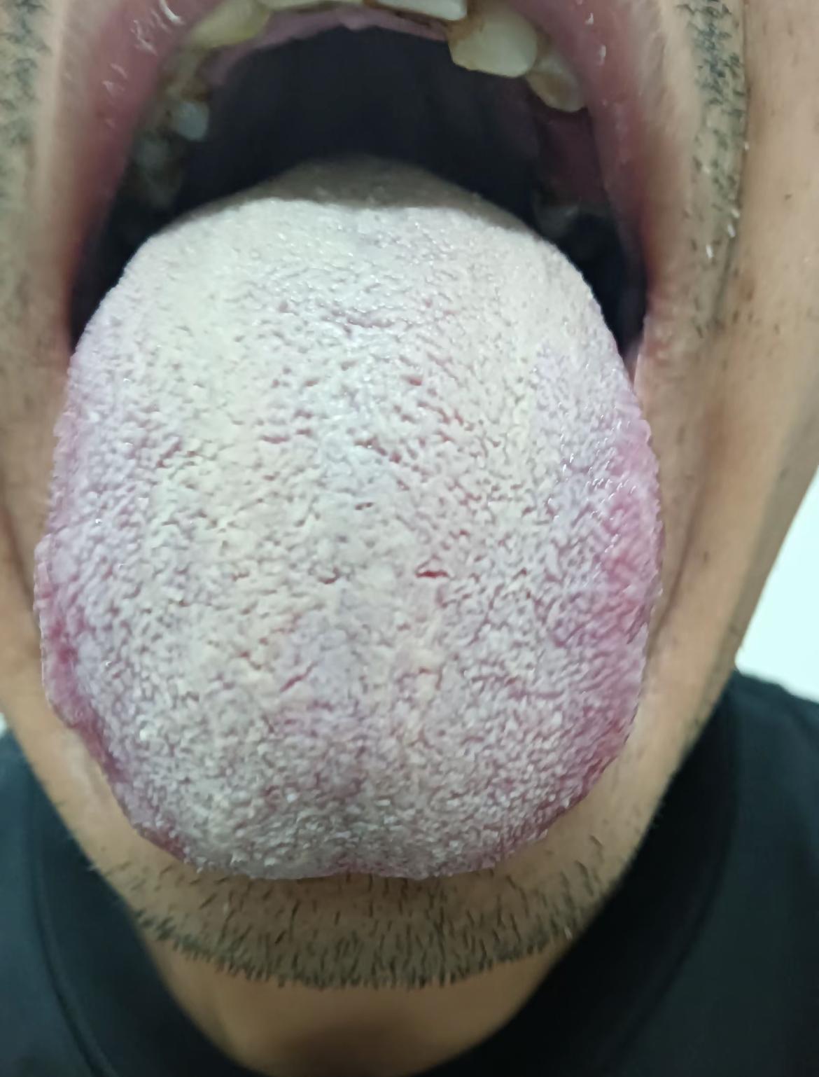 大哥就喜欢拖，拖拖拉拉，你这舌头就别考虑，吃中成药挽救了[擦汗]
这舌头真是，盖