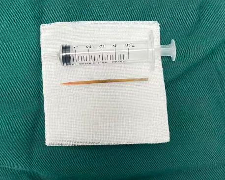 【喝水误吞牙签忍两天一查已肠穿孔：医生20分钟化险为夷】喝水时误吞一根牙签，险些