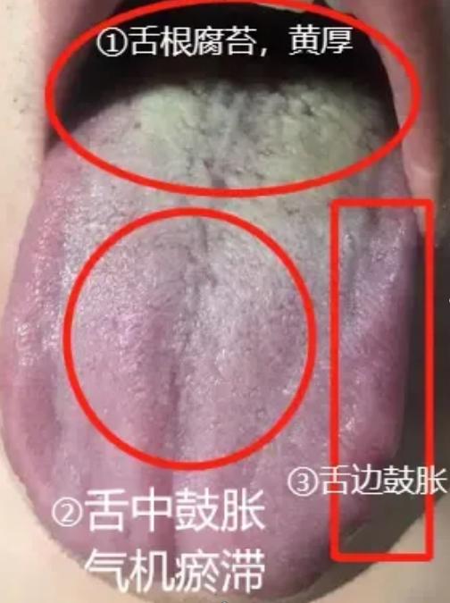 那方面差，看看舌根和舌边就知道！
 
患者平时觉得胸闷气短，情绪起伏不定，爱发脾