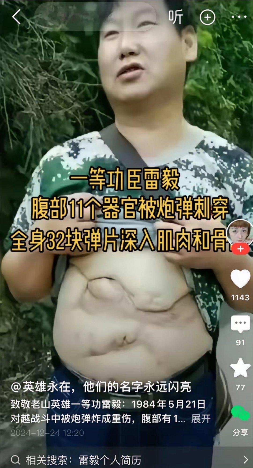 一等功臣雷毅，腹部被敌人炮弹炸开，11个器官被击穿，取出32块弹片，经过抢救战胜