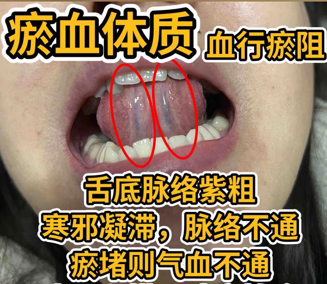 舌象分析 看看你是哪一种