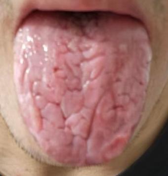 宗筋状态差盲目进补没用，如何分辨虚实？







顽固性的海绵体弱该如何调理