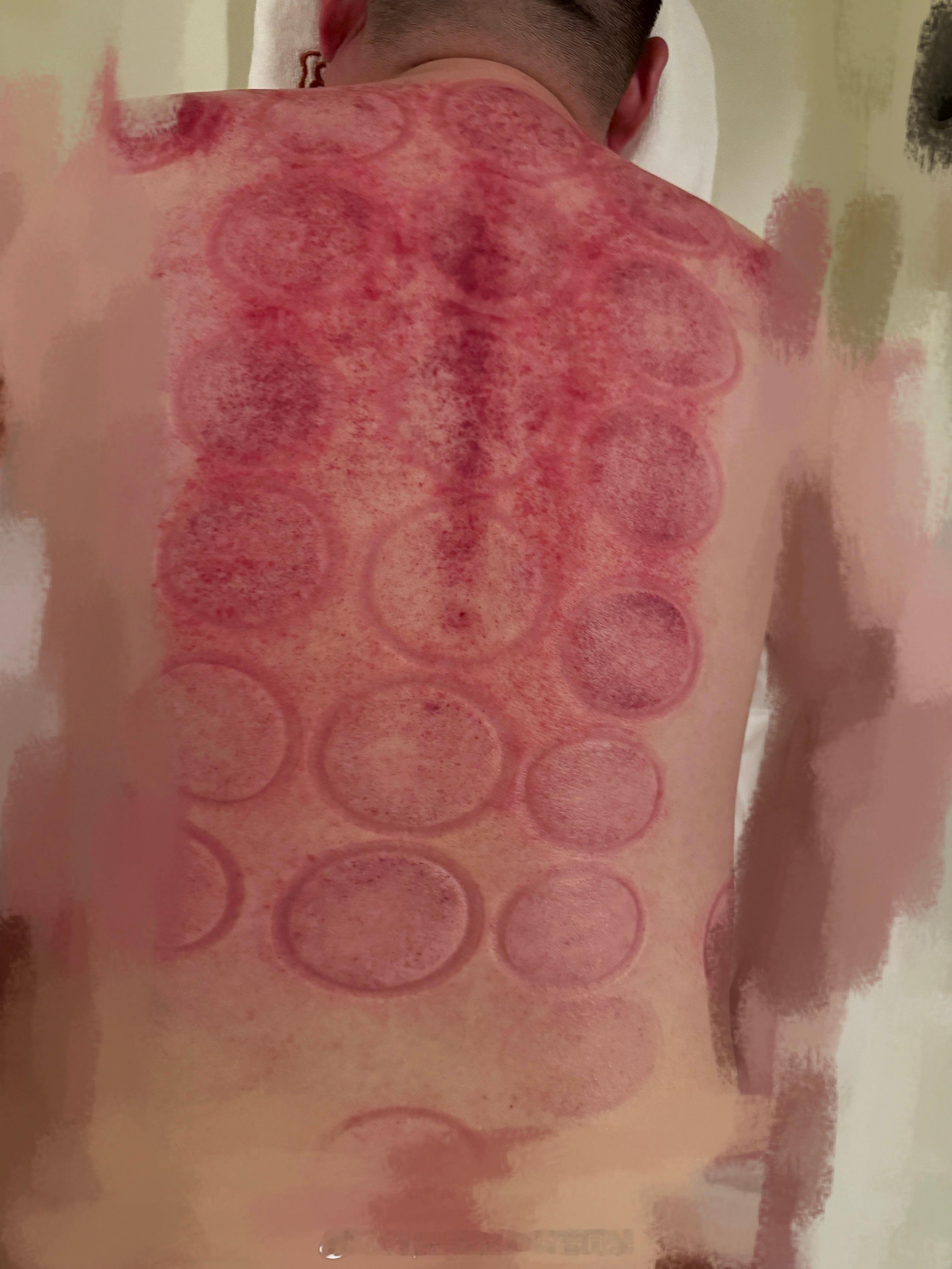 发烧的时候刮痧，真的爽[大哭] ​​​