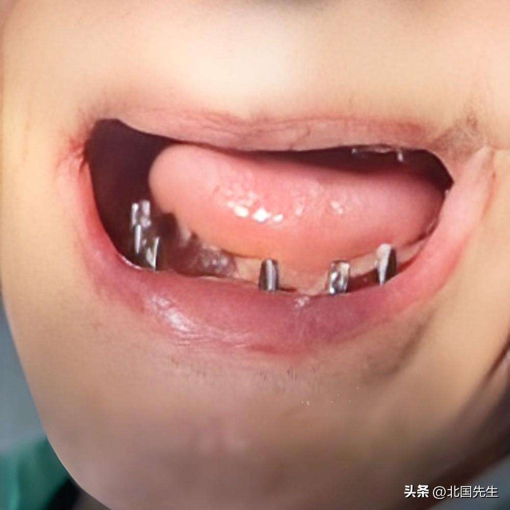 西安70岁老人种牙后离世，
一次性拔除6颗牙，
同期完成半口种植牙，费用2.1万