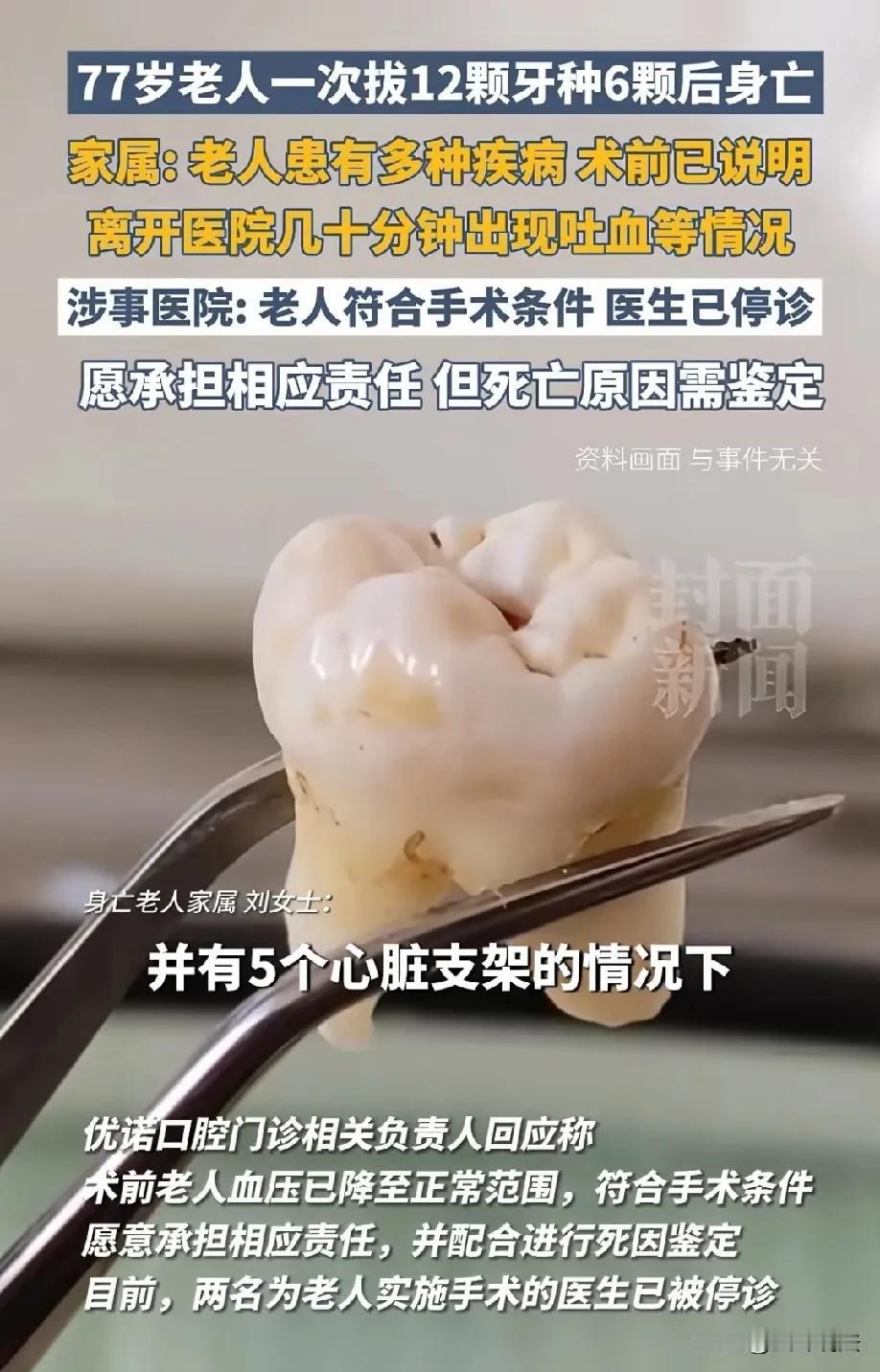黑龙江哈尔滨，77岁老人去医院看牙，医生一次性拔掉12颗牙，还给他种了6颗呀。老