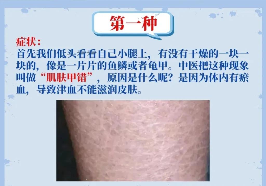 想知道血管堵不堵，不用去医院也能自查！一个简单的方法，通过观察腿脚就能判断。图文