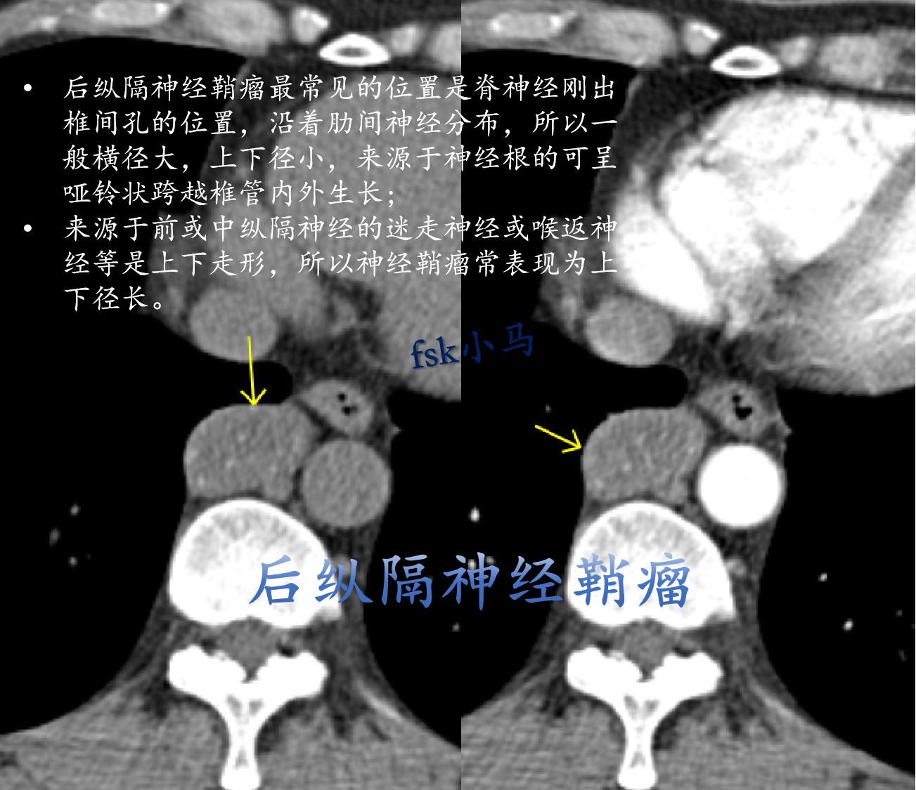 后纵隔神经鞘瘤