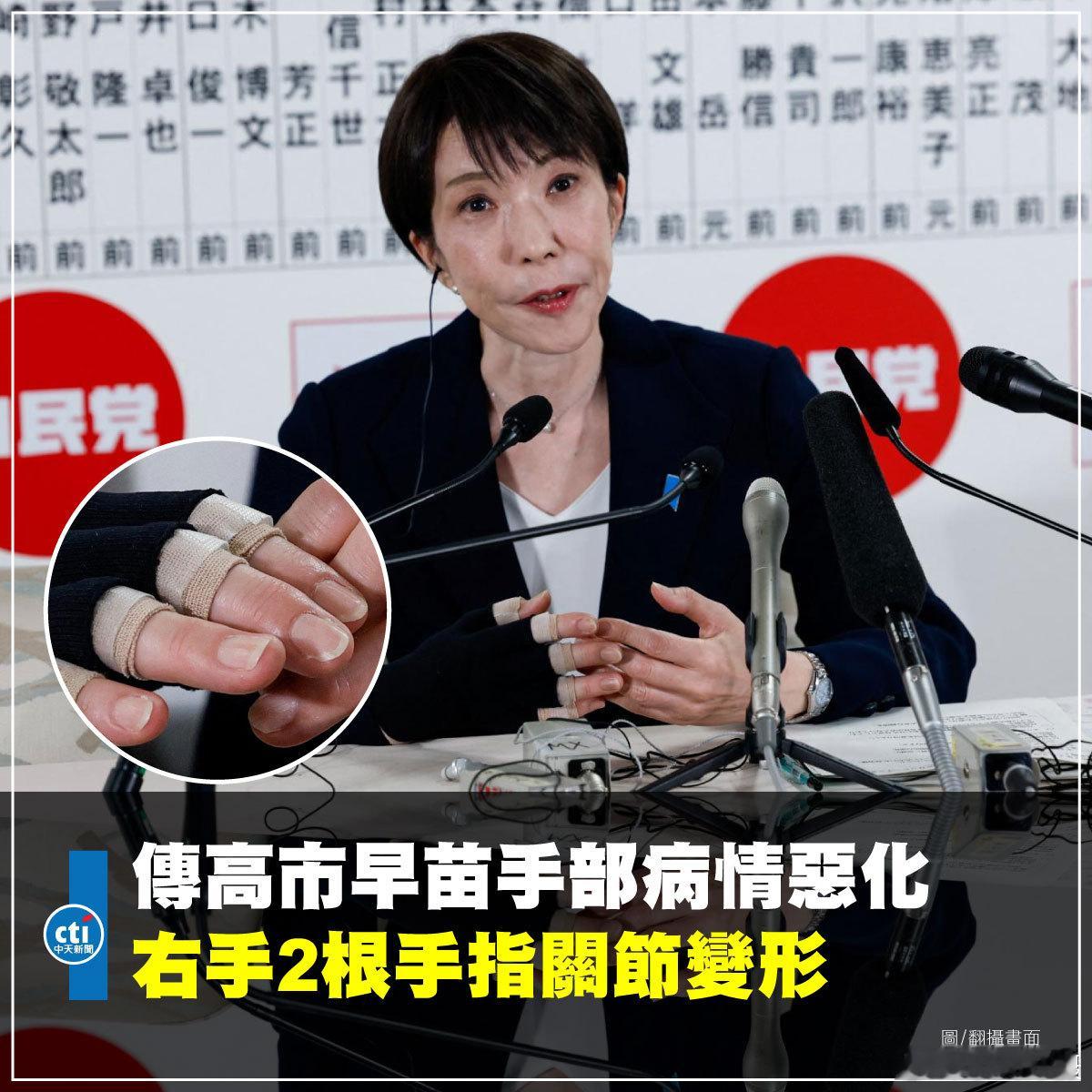 日本《每日新闻》称，高市早苗手部患有的类风湿性关节炎近期恶化，右手有两根手指的关
