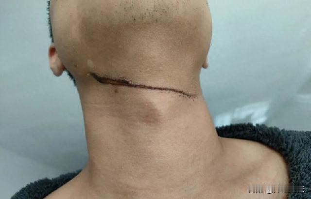 山东，一男子夜晚骑车回家，经过小区主干道避让对向车辆时，不小心被小区内晾衣绳割伤