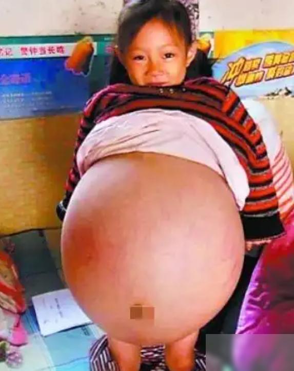 山西一4岁小女孩，肚子异常鼓胀，大得像足月孕妇。多家医生轮番看过后，家里听到的多