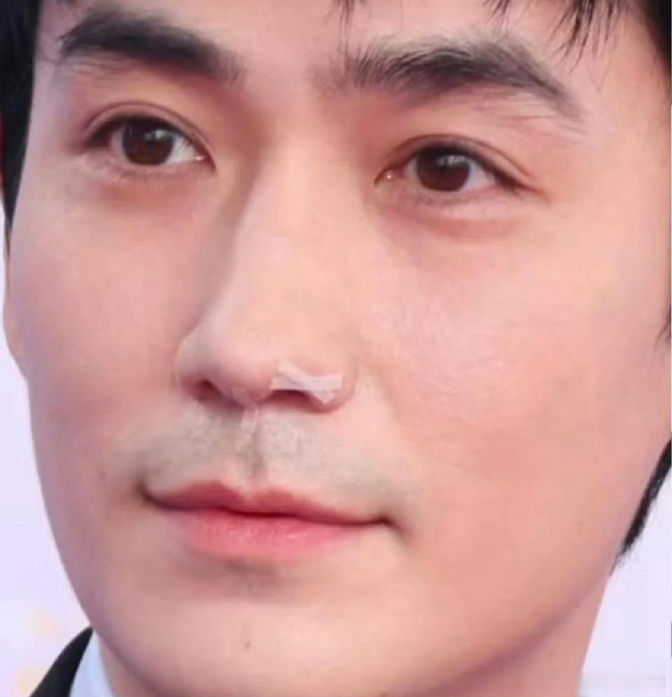 朱一龙鼻子怎么了朱一龙出席百花奖提名仪式，鼻子上贴了东西，这是怎么了 