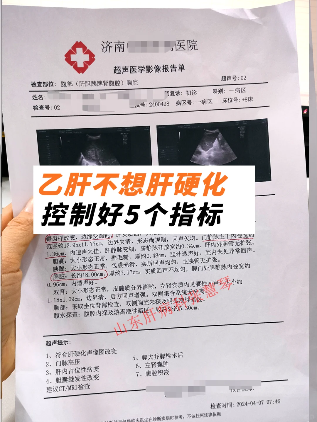 乙肝不想肝硬化，控制好这5个指标↓↓↓