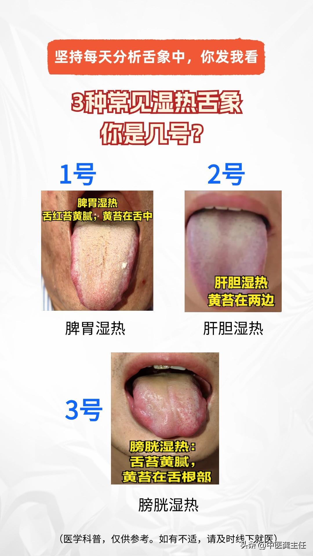 坚持每天公益舌诊中，今天分享3种常见湿热舌象
你是几号呢？

1.脾胃湿热（食欲