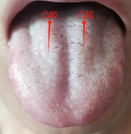 凸起舌，舌中高凸用这一味药很有效！
 
中医认为，舌中脾胃区凸起，提示脾胃不顺畅