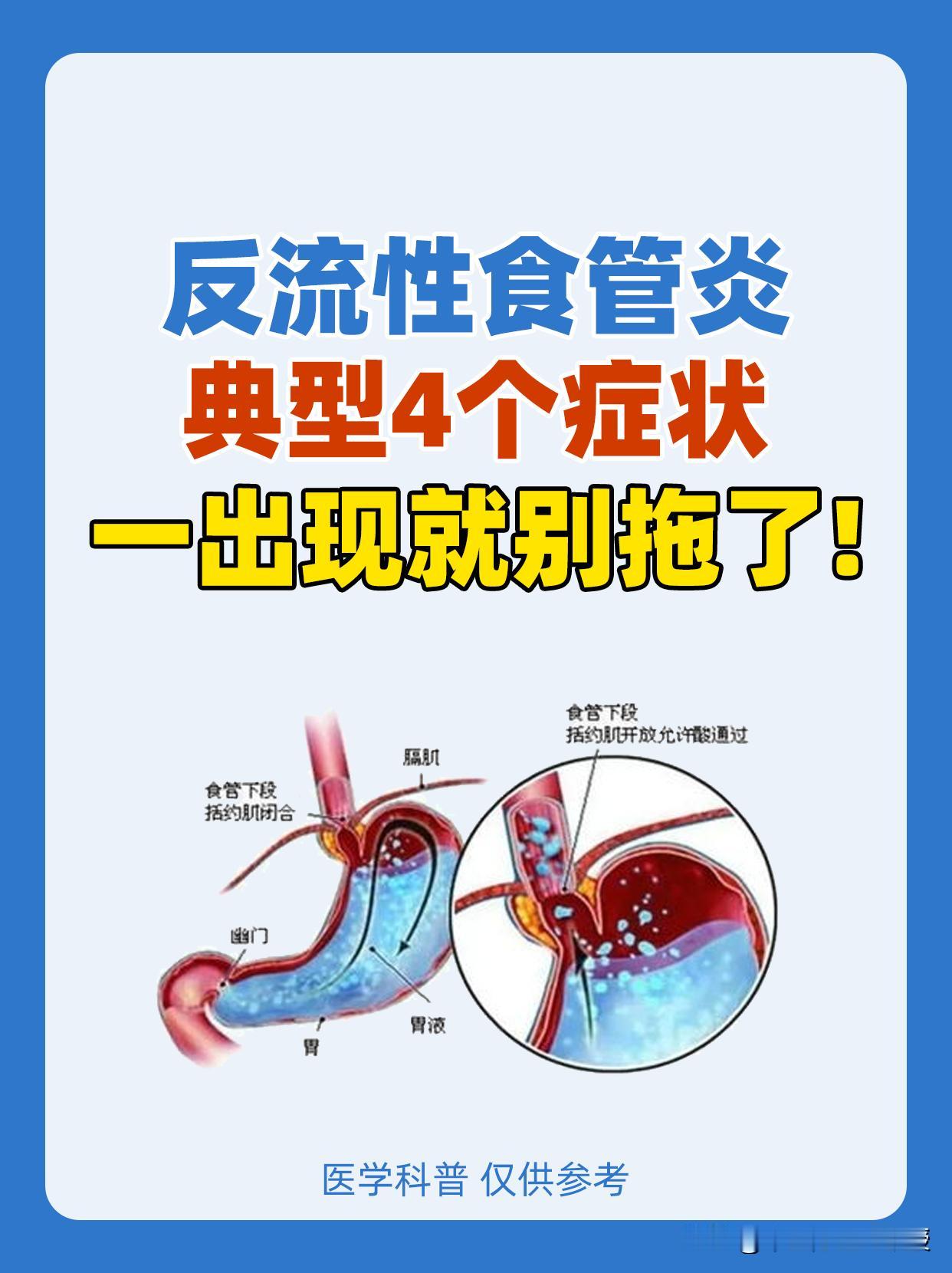 反流性食管炎，典型4个症状，一出现就别拖了！