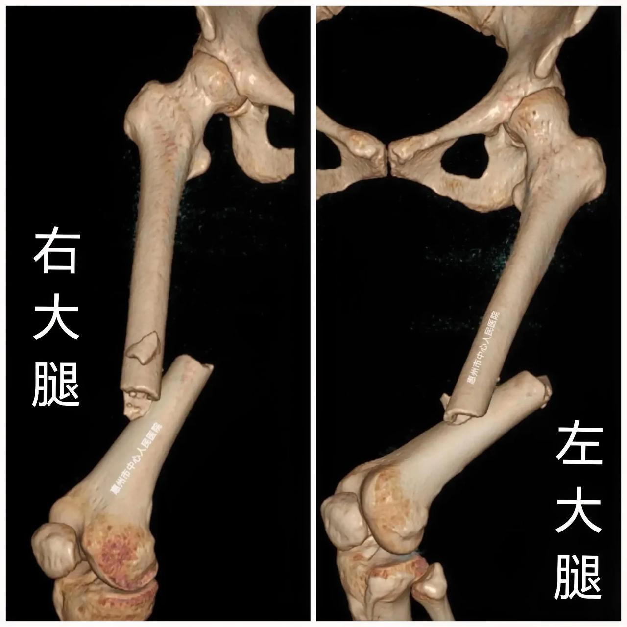 大过年！[发怒]
高速追尾，大腿骨骨折！

春节期间，开车回家，探亲访友，都是高