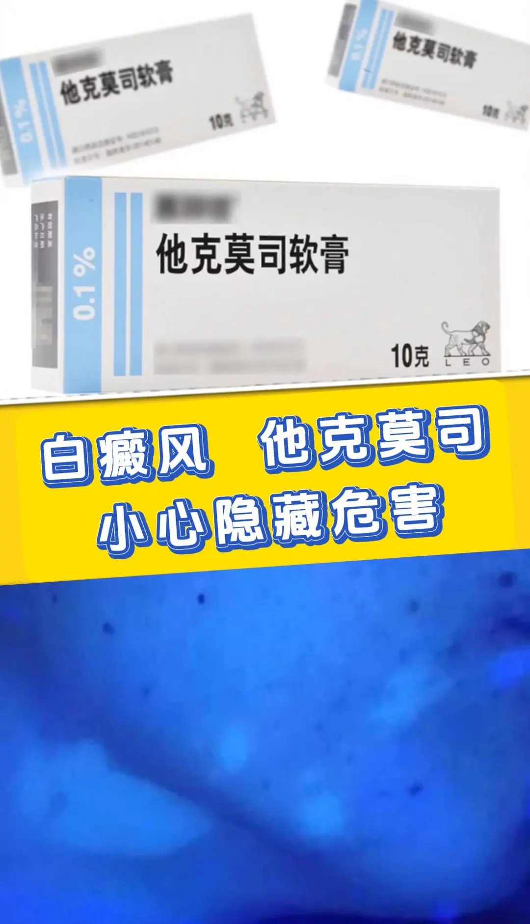 他克莫司治疗白癜风，这些副作用你必须知道 1、皮肤刺激： 根据临床研究...