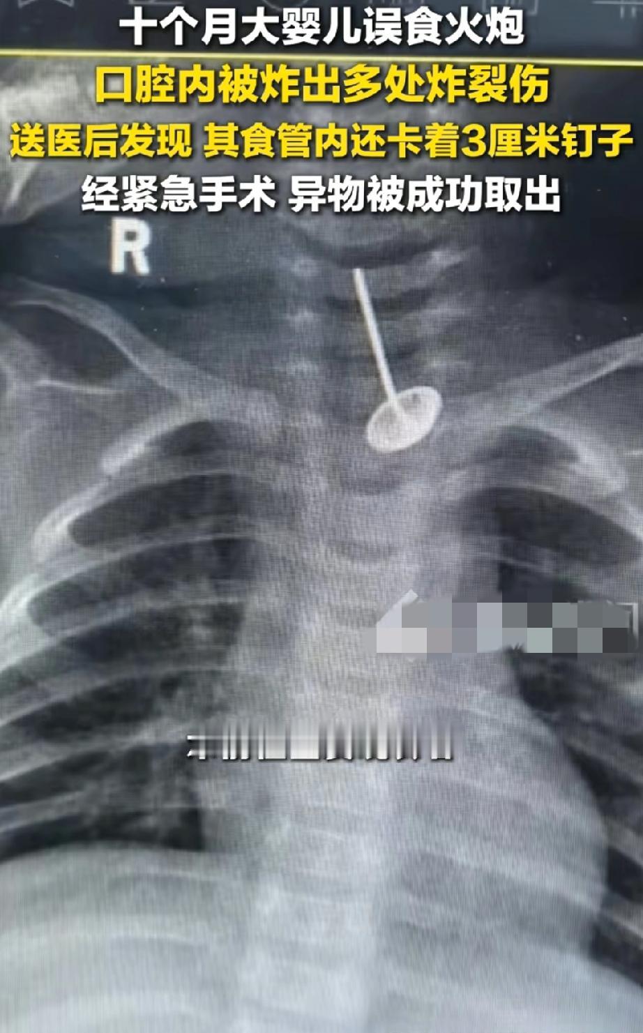 10个月宝宝误食摔炮、钉子，真的是意外吗？

一个10个月大的婴儿误食摔炮炸伤口