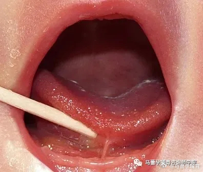 问：舌系带短对于母乳喂养有哪些影响？ 舌系带过短怎么办哺乳疼痛享喂母乳喂养咨询母