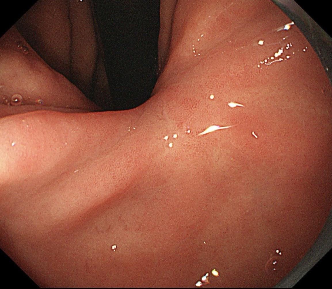 胃窦微小病变，和上次的那个好像啊～胃早癌ESD术后复查，萎缩背景明显...