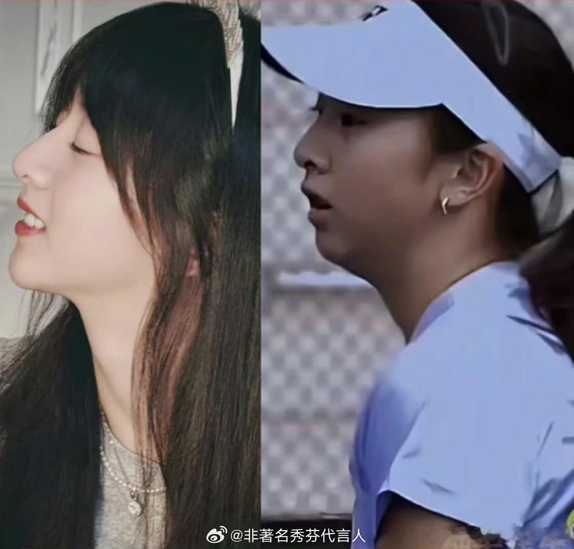 森碟下巴后缩矫正好了变化真的挺大的 颌面对颜值影响太大了 感觉得感谢网友声讨