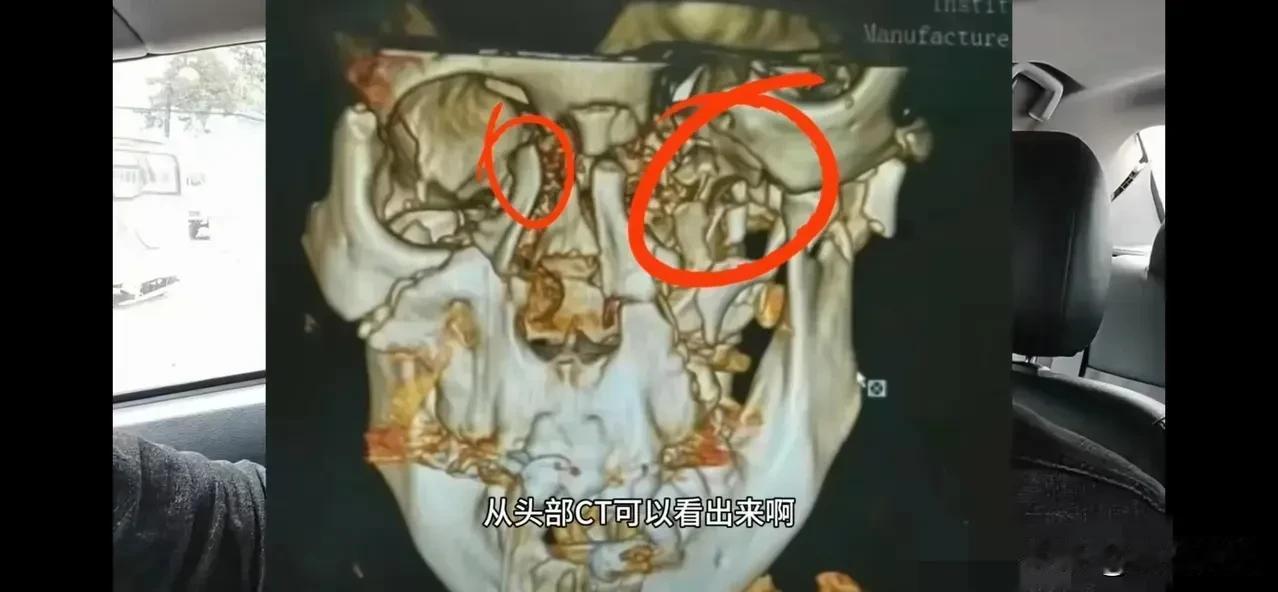 孩子还有呼吸，就被活埋了，尸检曝光，孩子的呼吸道内吸入泥土，说明孩子被埋在大棚内